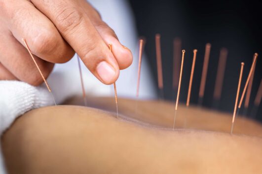 Acupuncture Treatment