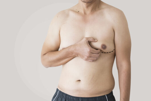 Gynecomastia