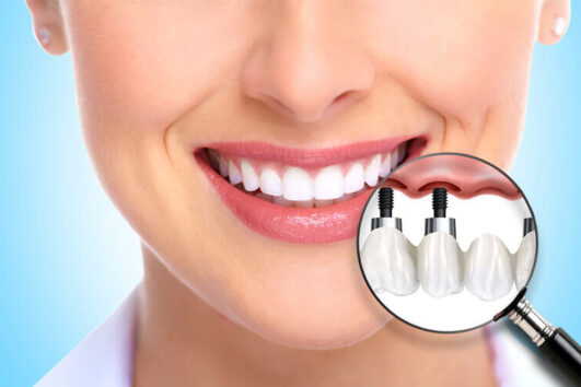 Dental Implant