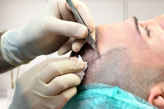 Percutaneous Hair Transplant