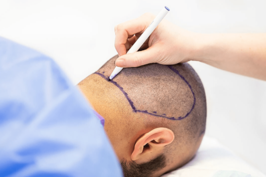 Painless Unshaven Hair Transplant