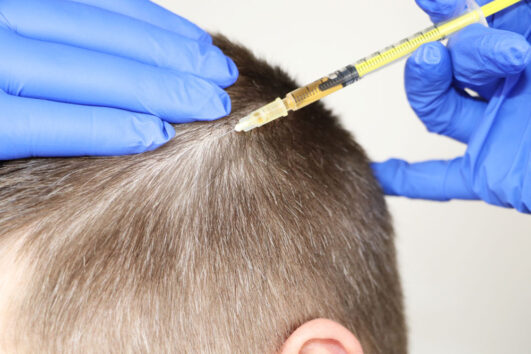 Hair Mesotherapy
